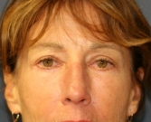 Feel Beautiful - Eyelid Surgery San Diego Case 47 - After Photo